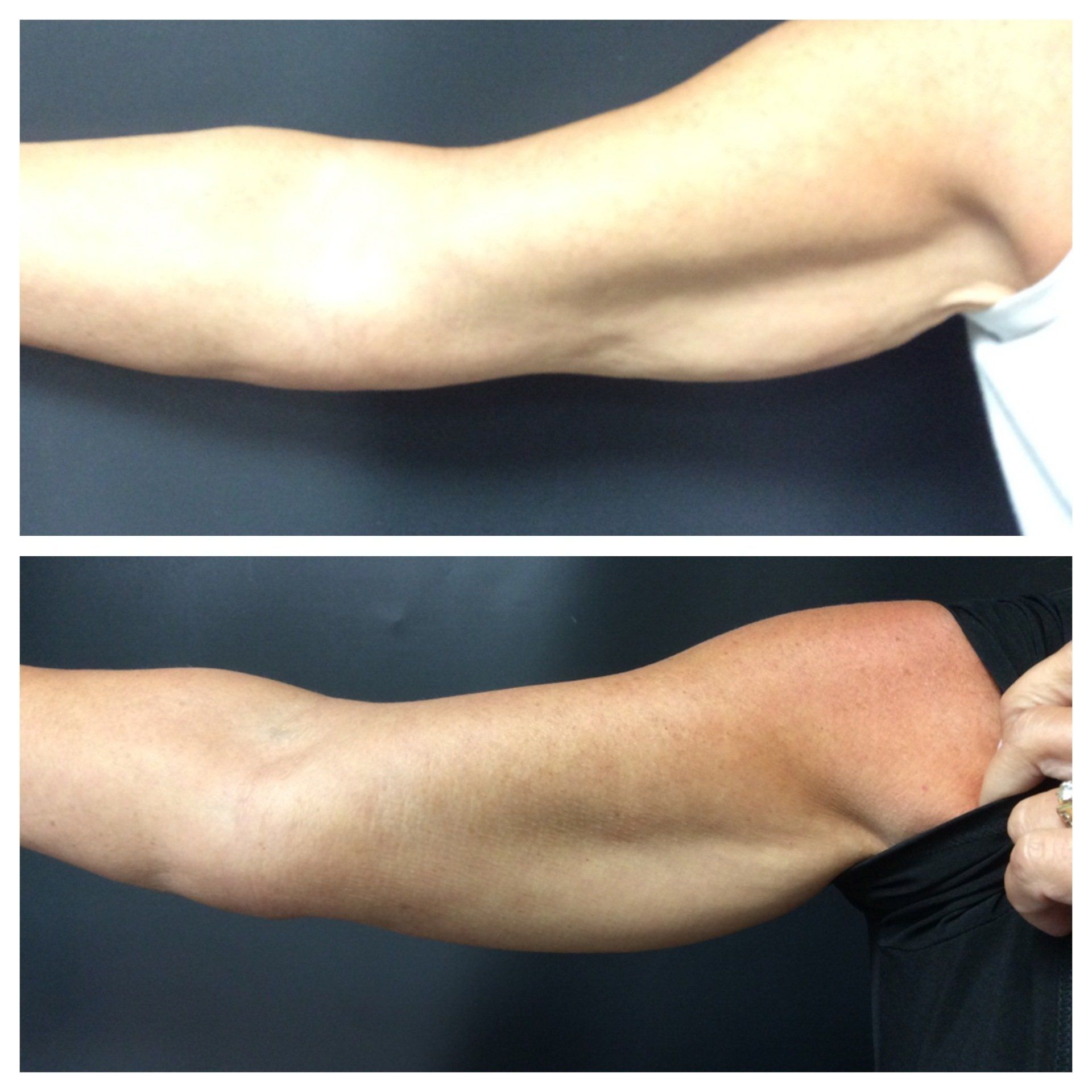 Before and After at Conway Med Spa