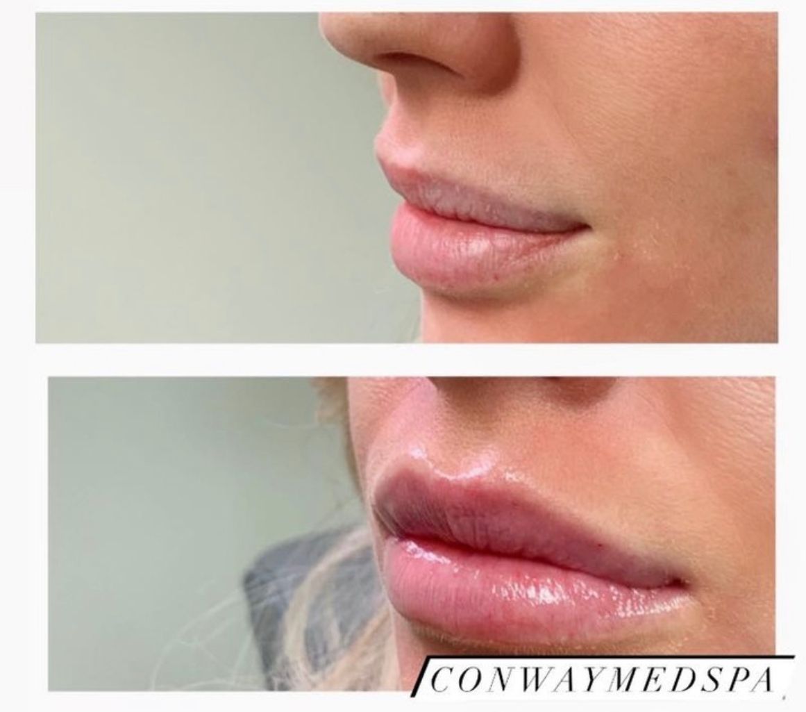 Before and After Lip Injections at Conway Med Spa