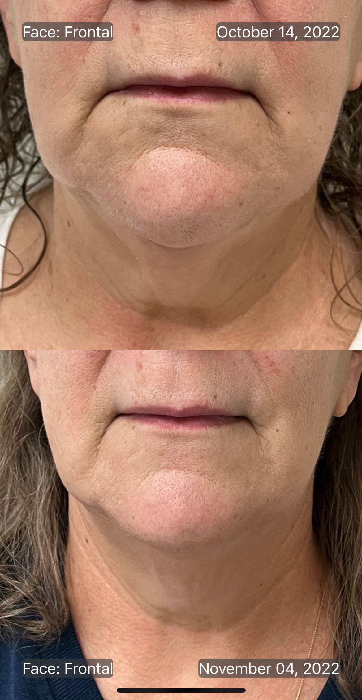 Skin Tightening at Conway Med Spa