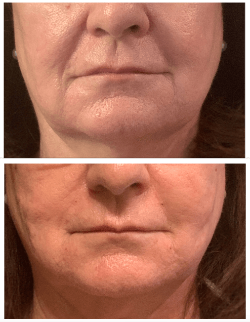 Before and After at Conway Med Spa