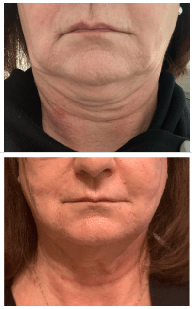 Before and After at Conway Med Spa