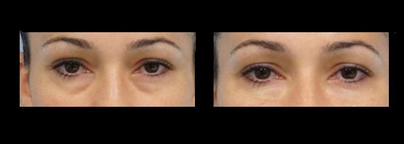 blefaroplastia en chihuahua