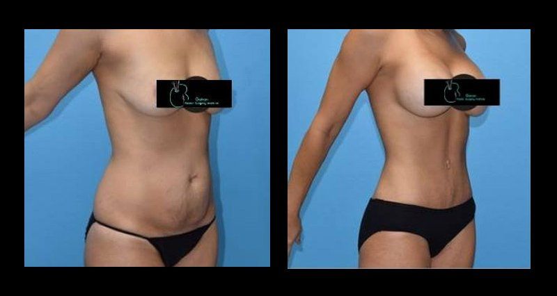 lipoescultura en chihuahua