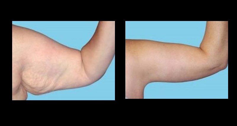 lipoescultura en chihuahua