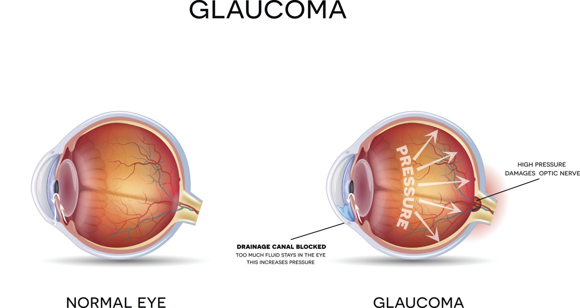 Glaucoma — Tupelo, MS — Tupelo Eye Center