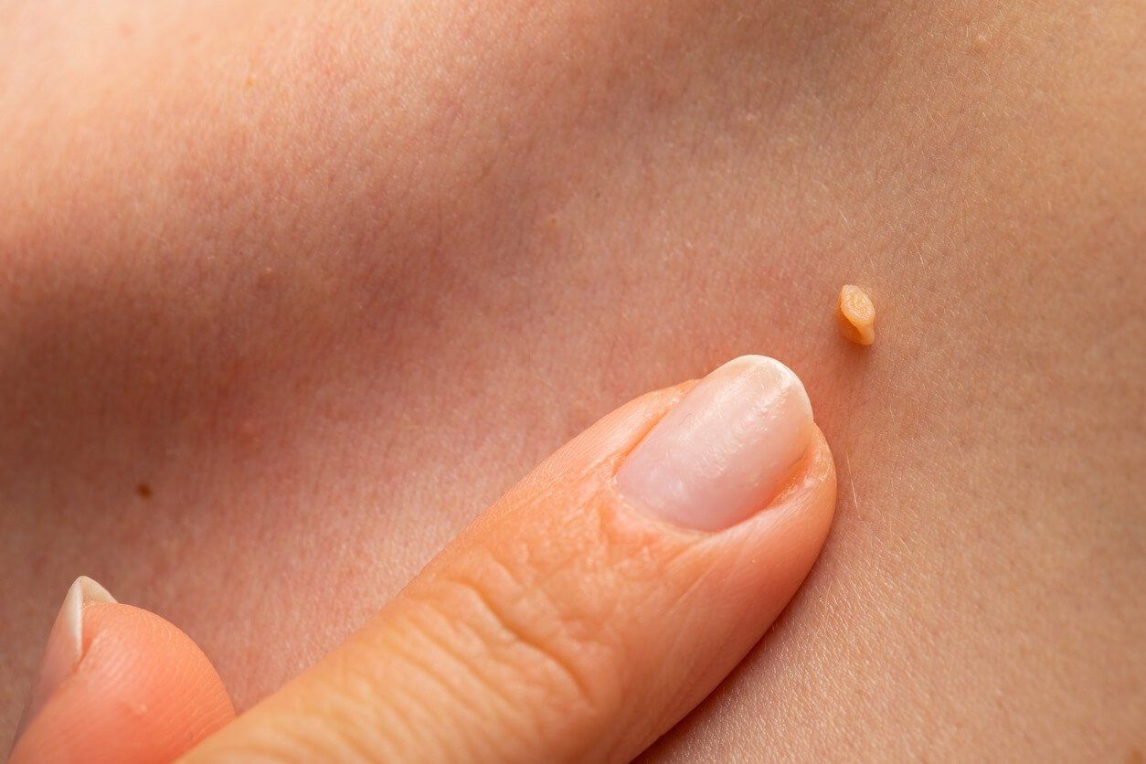HPV e a pele