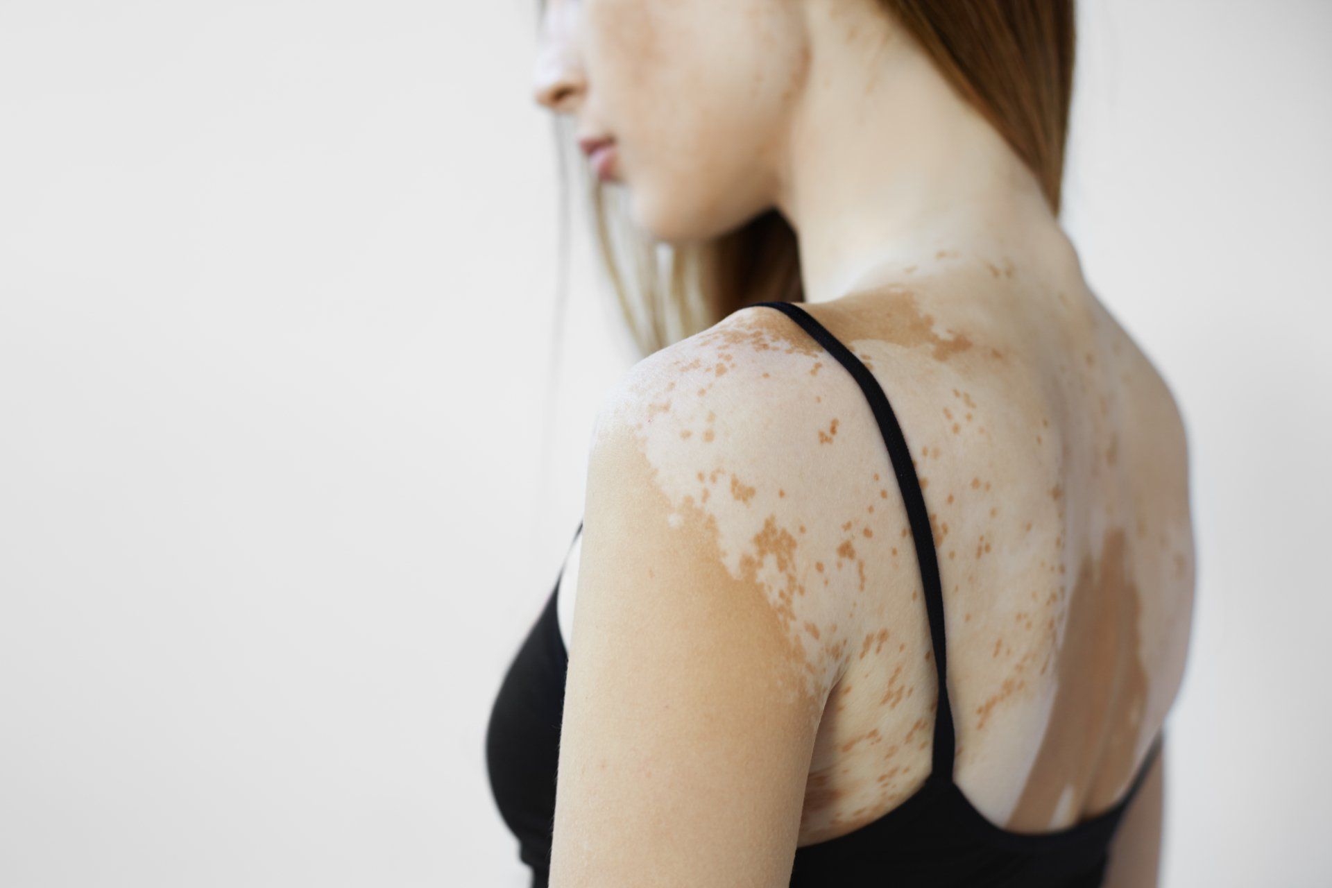 Uma mulher com vitiligo no ombro e nas costas está vestindo uma blusa preta.