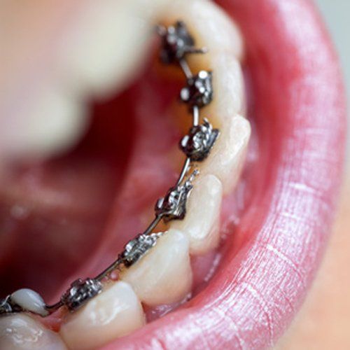 A picture of braces in a persons' mouth