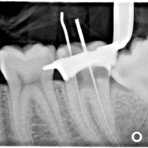 An X-ray of a root canal procedure