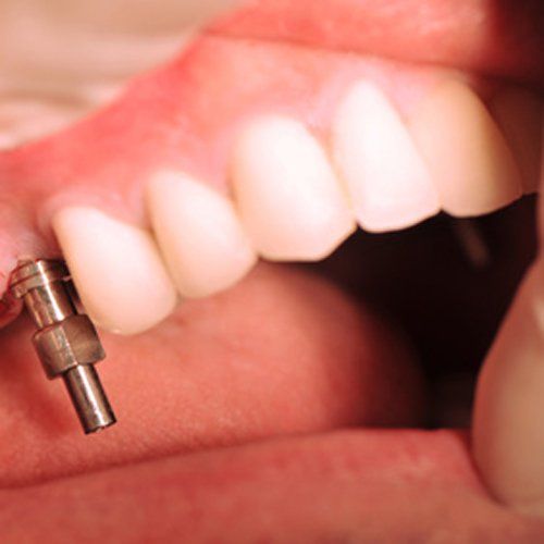 A picture of a metal dental implant in someone's mouth