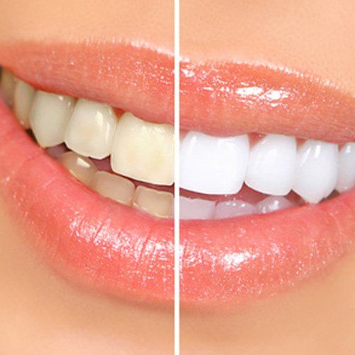 A picture of a person smile before and after teeth whiting