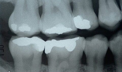 X-ray teeth - Crowns Bridges in Farmingdale, NY