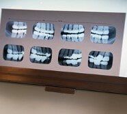 X-ray - Teeth whitening in Farmingdale, NY