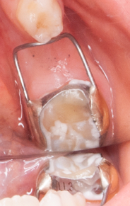 A woman having her teeth cleaned by her dentist