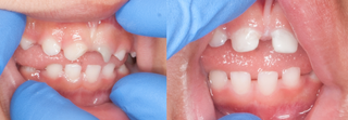 A woman having her teeth cleaned by her dentist