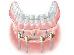 Dental Implant
