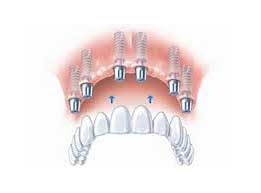 Dental Implant