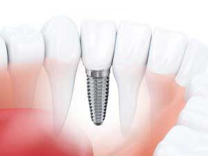 Dental Implant