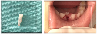 A woman having her teeth cleaned by her dentist