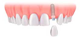 Dental Implant