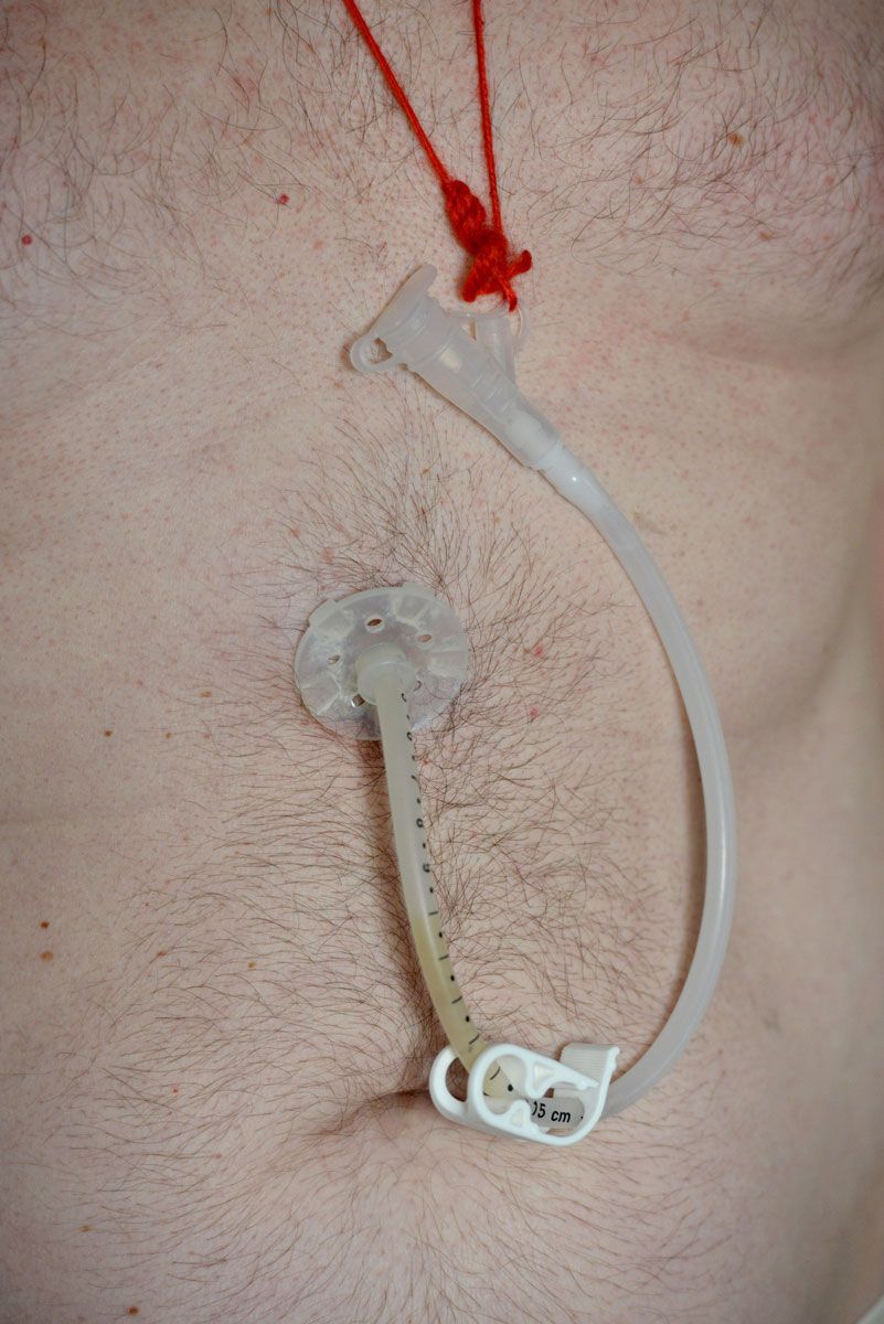 A person's abdomen with a gastrostomy tube inserted for feeding. The tube is secured with a red string.