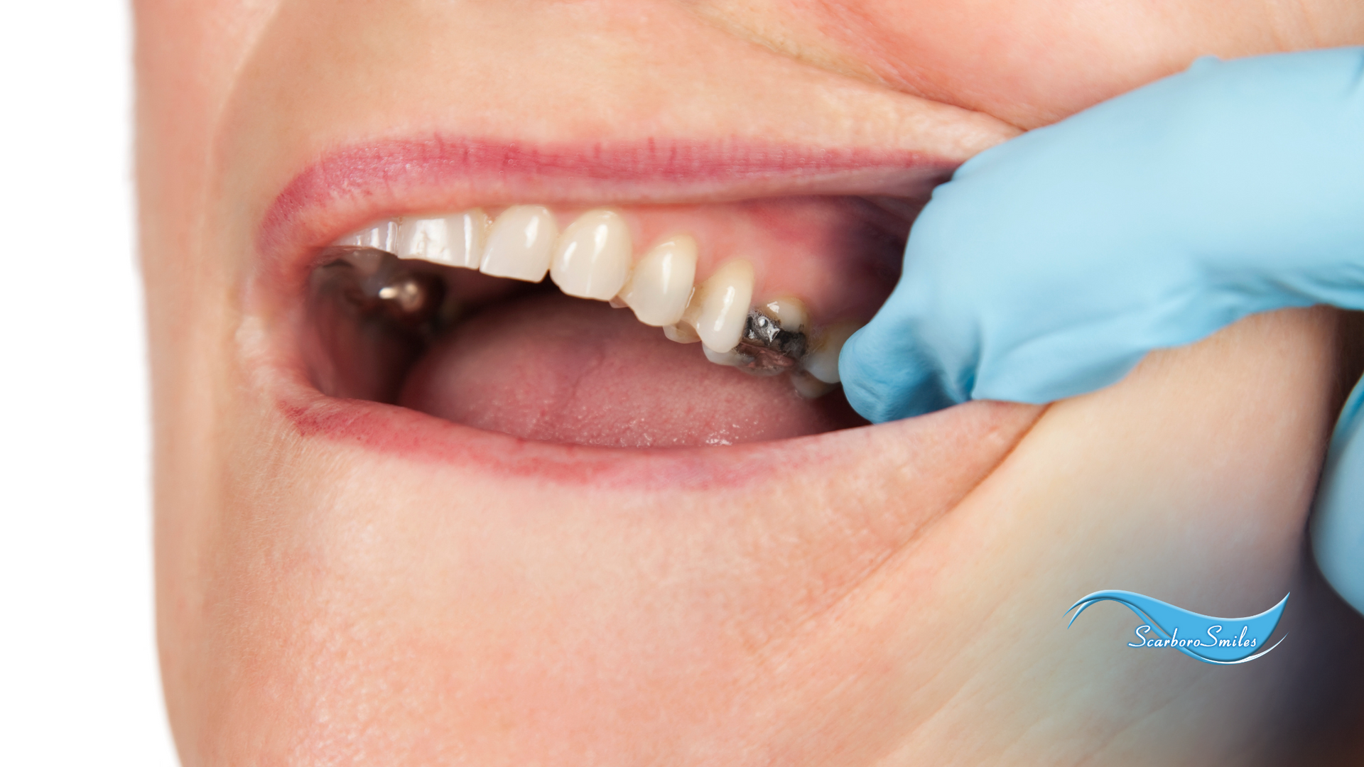 A close up of a person 's mouth with braces on their teeth.