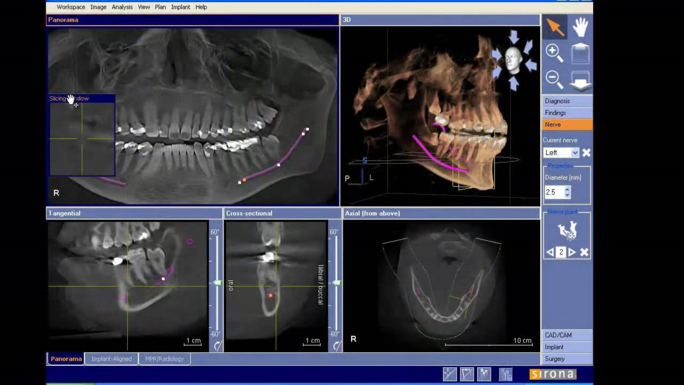 Cone Beam 3d x-ray of teeth