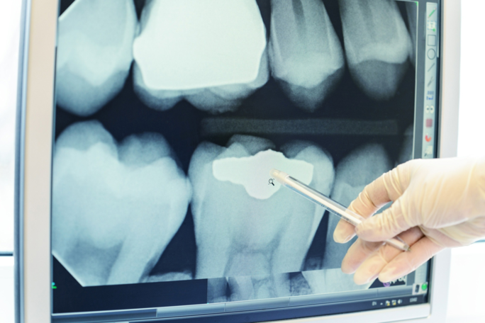 Dentist looking at digital  x-ray of teeth on computer monitor