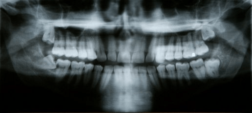 X-ray of impacted teeth