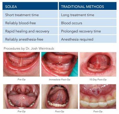 Solea technology is the best solution for tongue ties