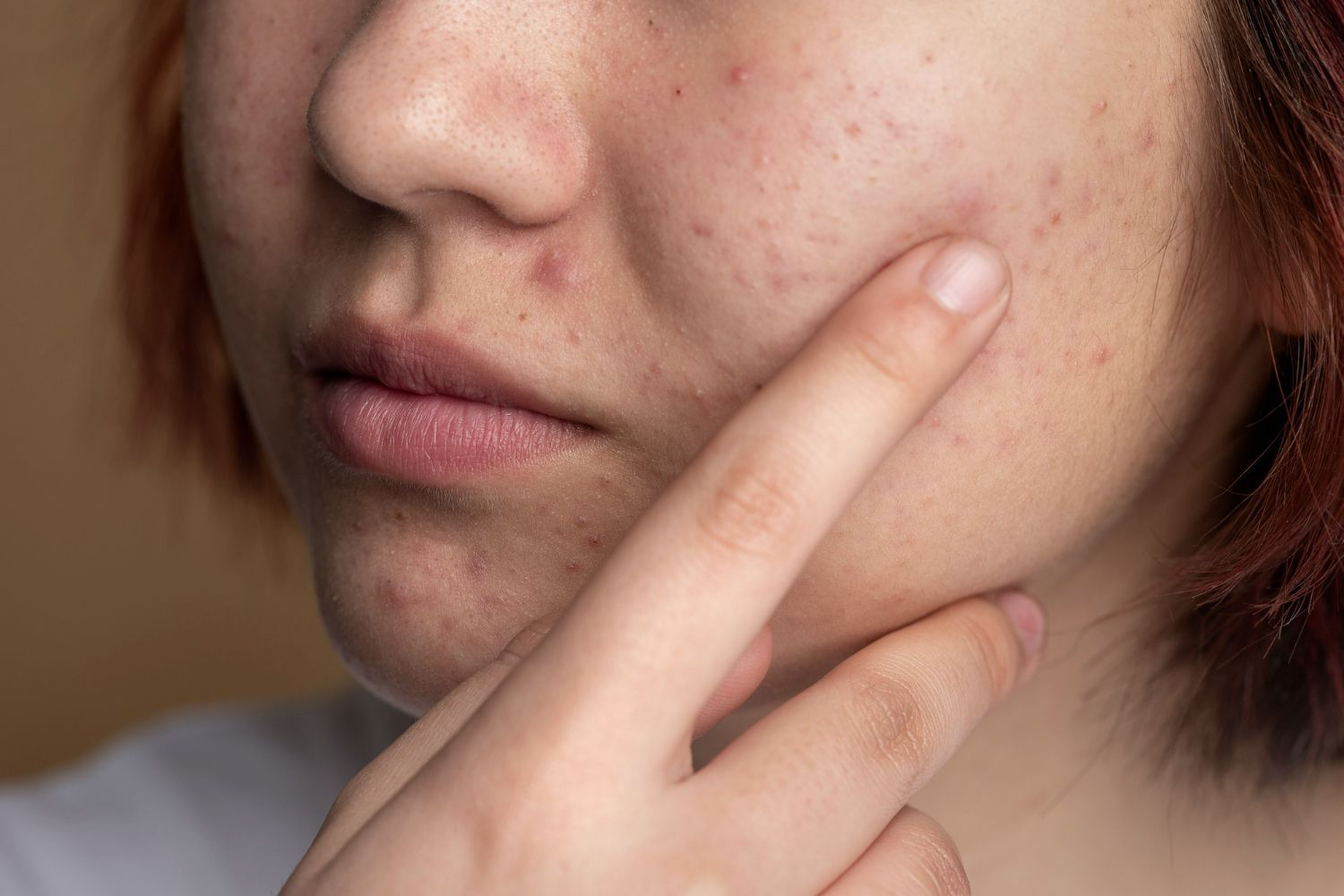 A woman with acne on her face is touching her face with her finger.