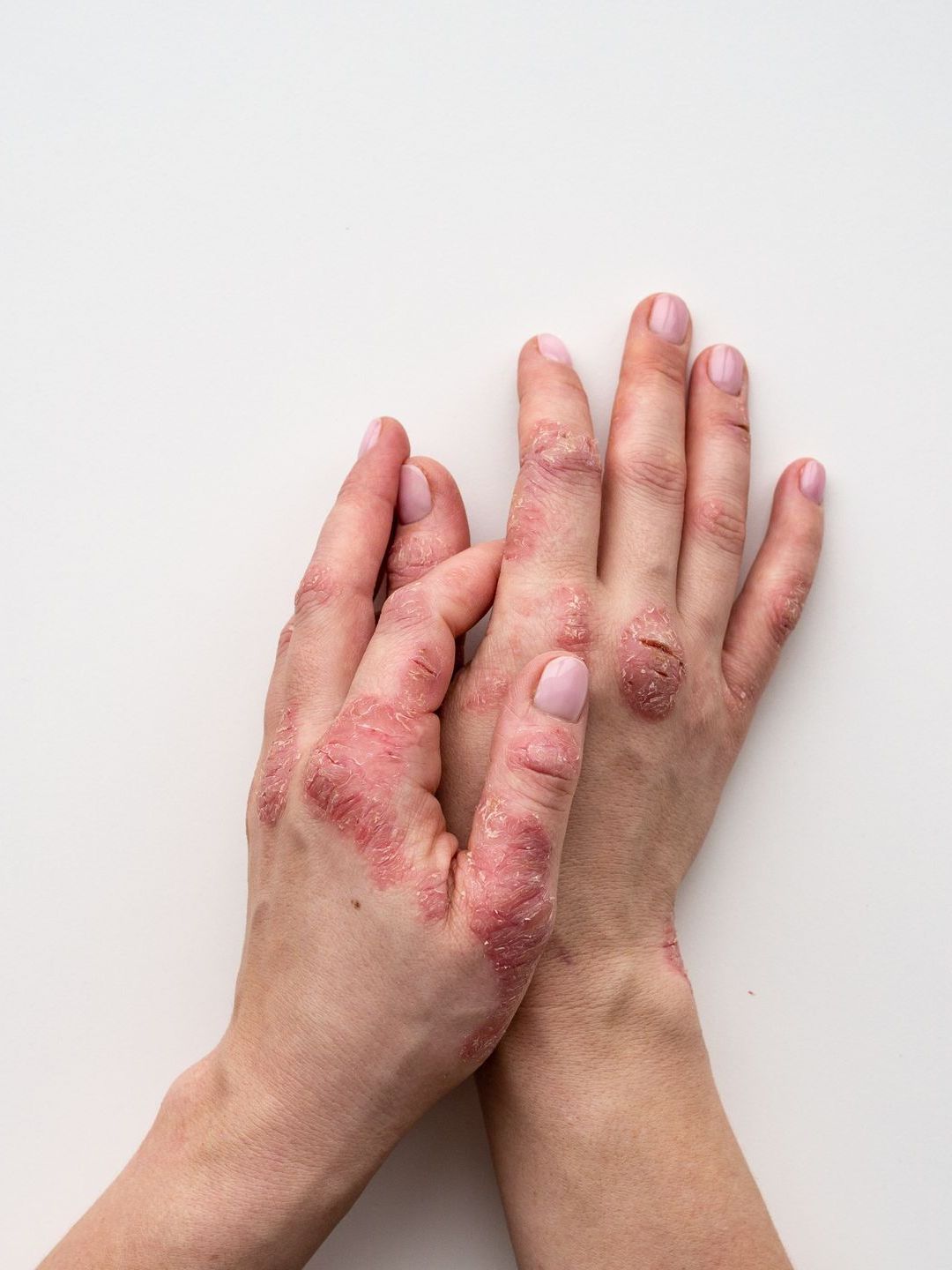 a woman 's hands with psoriasis on them on a white background .