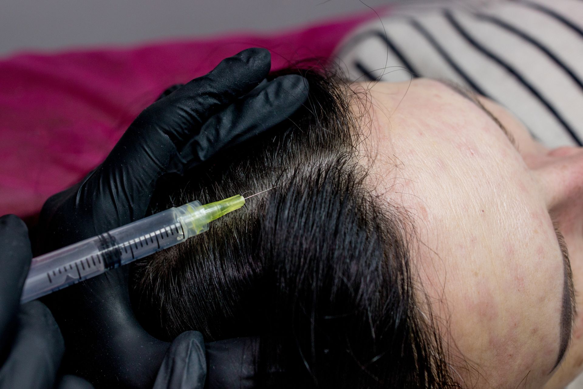 Person receiving a scalp injection for hair loss treatment. A gloved hand holds a syringe near the scalp.