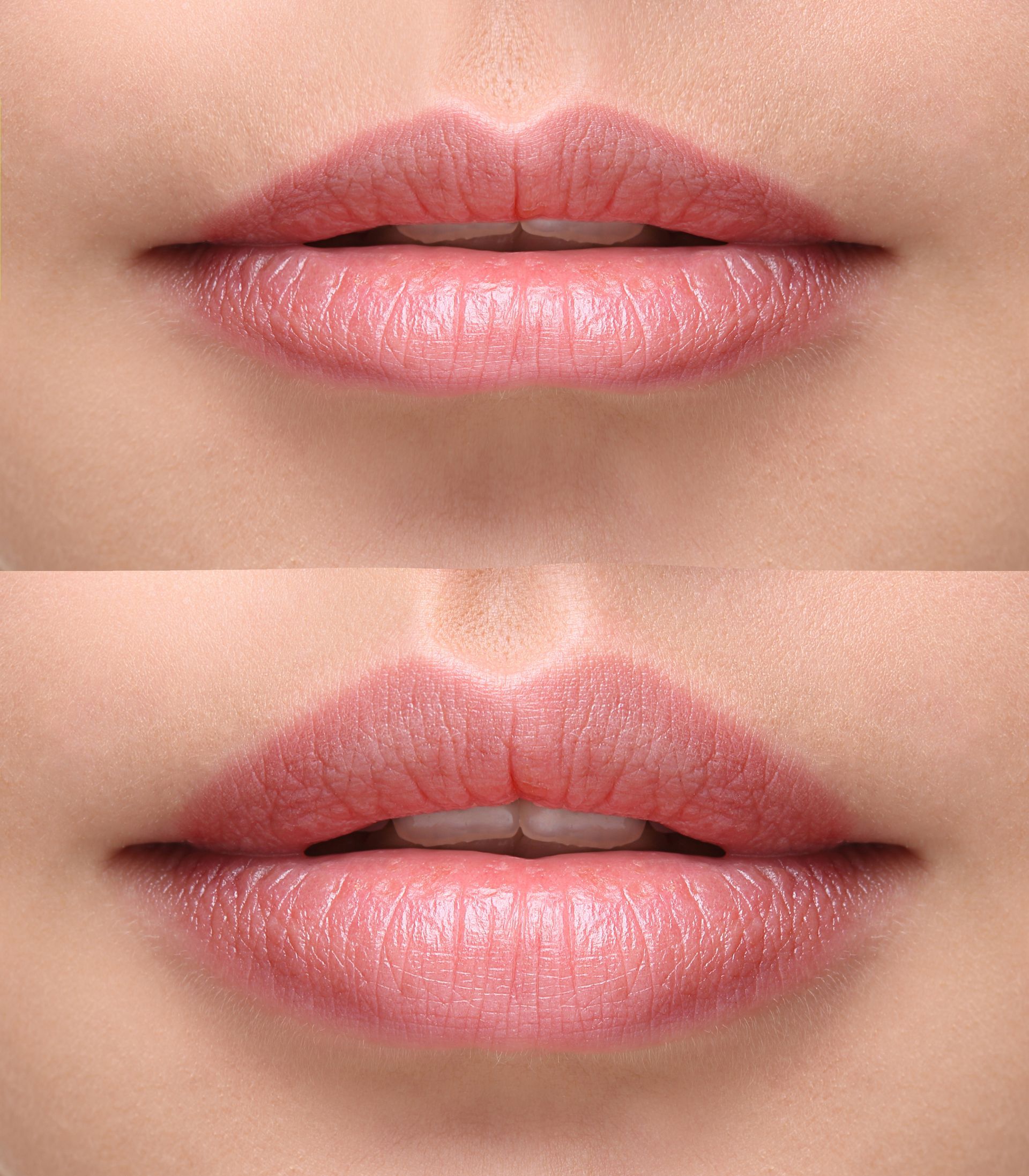 lips before and after fillers