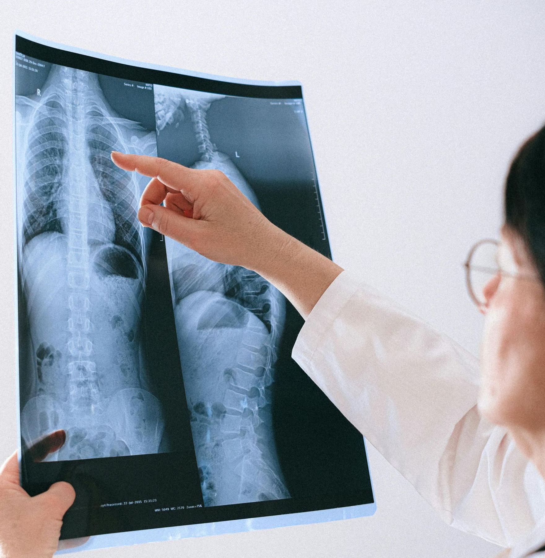 A doctor is pointing at an x-ray of a person 's chest.