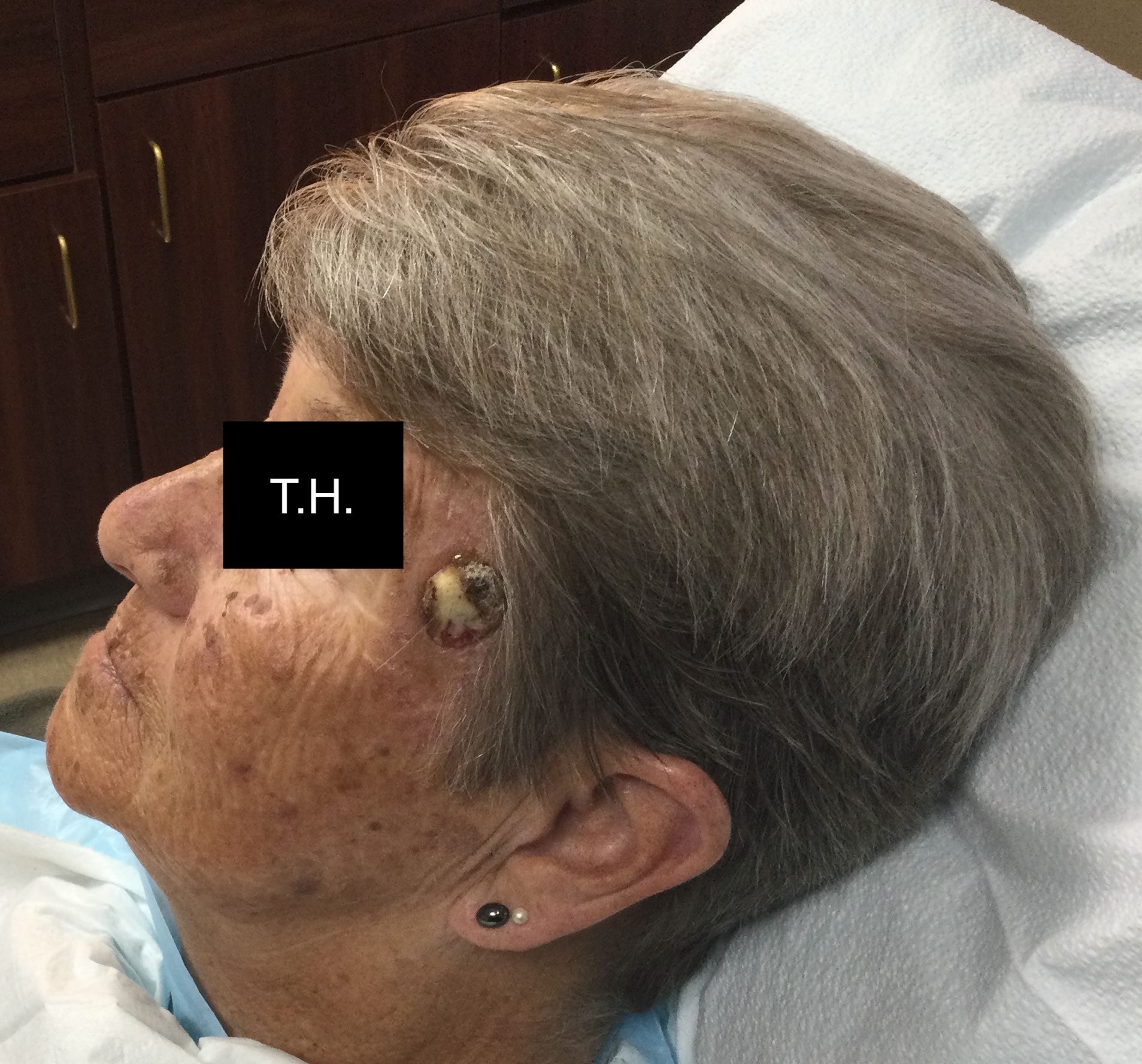 Woman's profile with skin cancer on her cheek at Advanced Dermatologic Surgery.