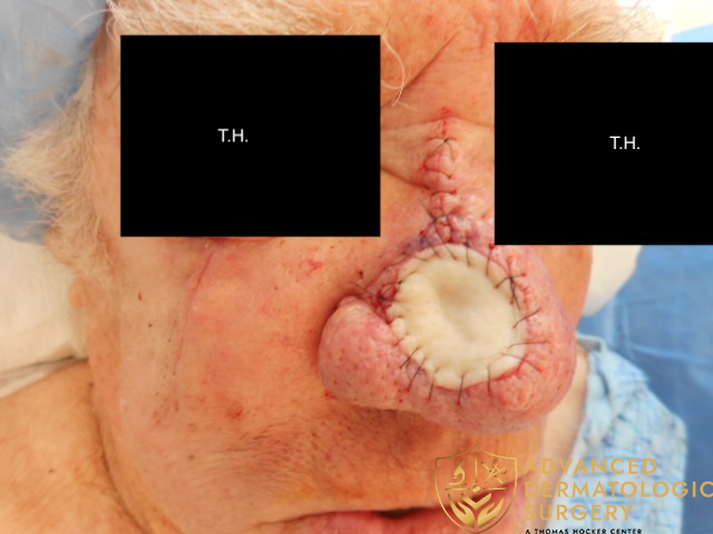 Surgical reconstruction of a nose; skin graft and stitches visible at Advanced Dermatologic Surgery.
