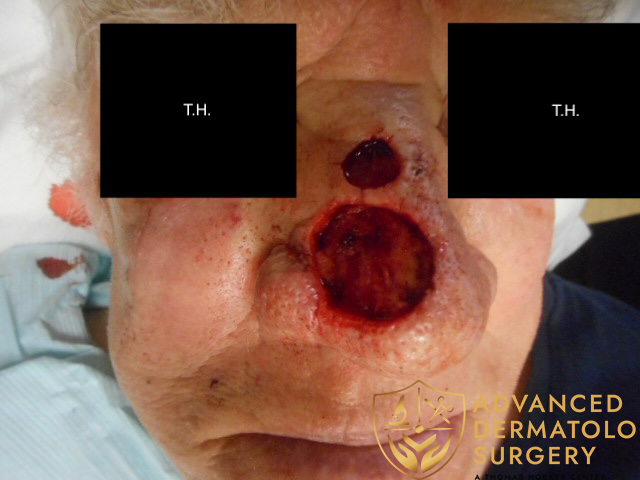 Close-up of a man's nose following Mohs Surgery at Advanced Dermatologic Surgery