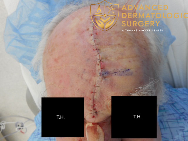 Complex Linear Closure at Advanced Dermatologic Surgery