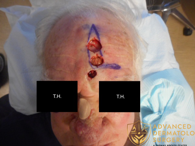 Mohs surgery to remove skin cancer Advanced Dermatologic Surgery