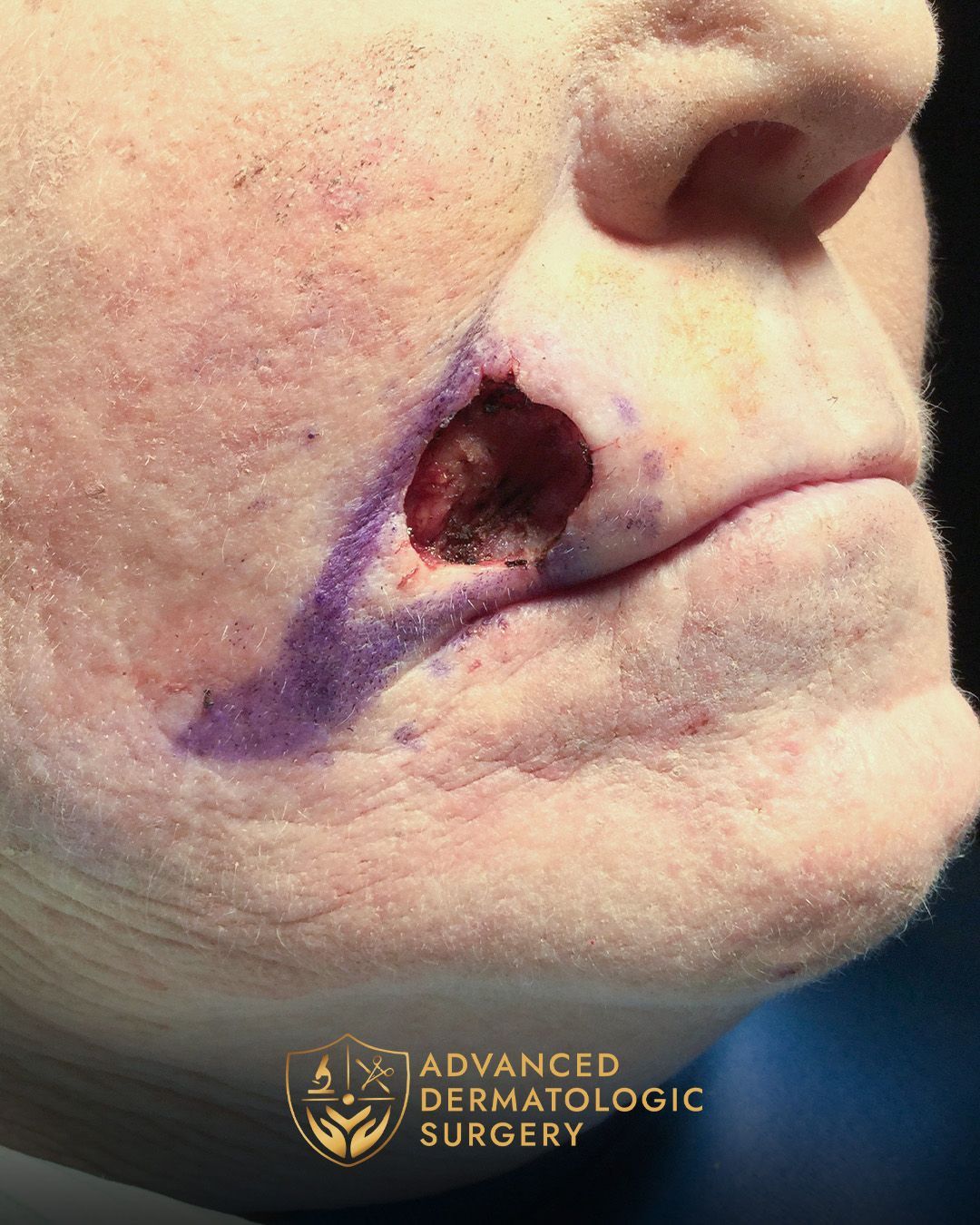 Close up of a woman's mouth after Mohs surgery