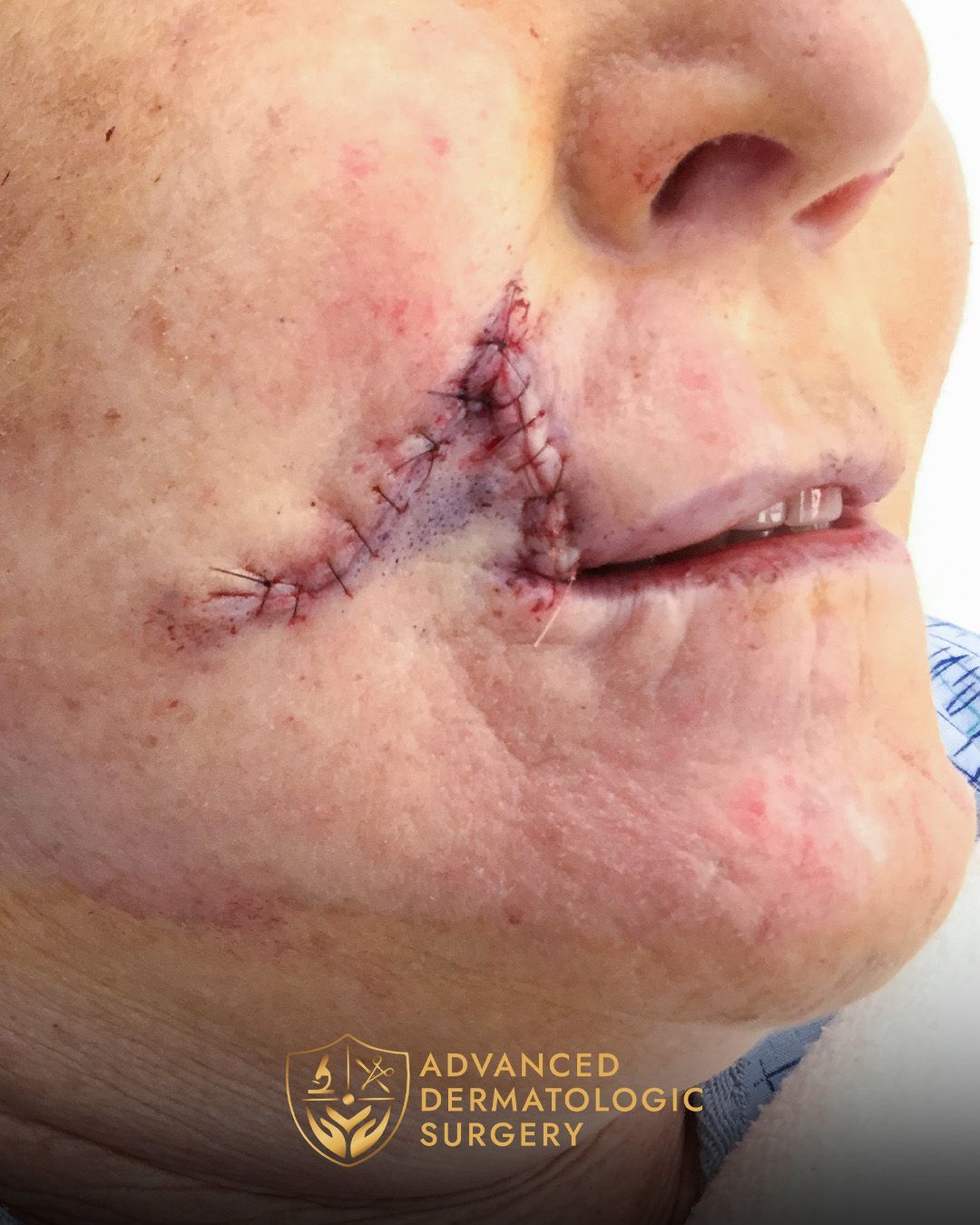 Close up of a woman's mouth after receiving reconstructive surgery