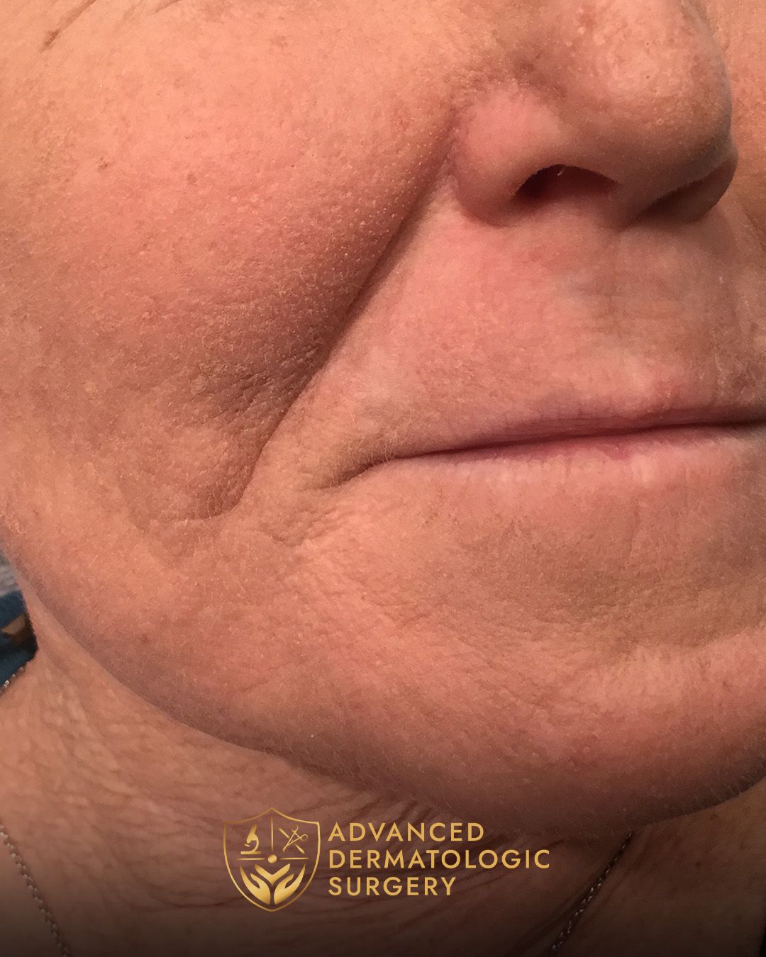 Close up of a woman's mouth after fully healing 