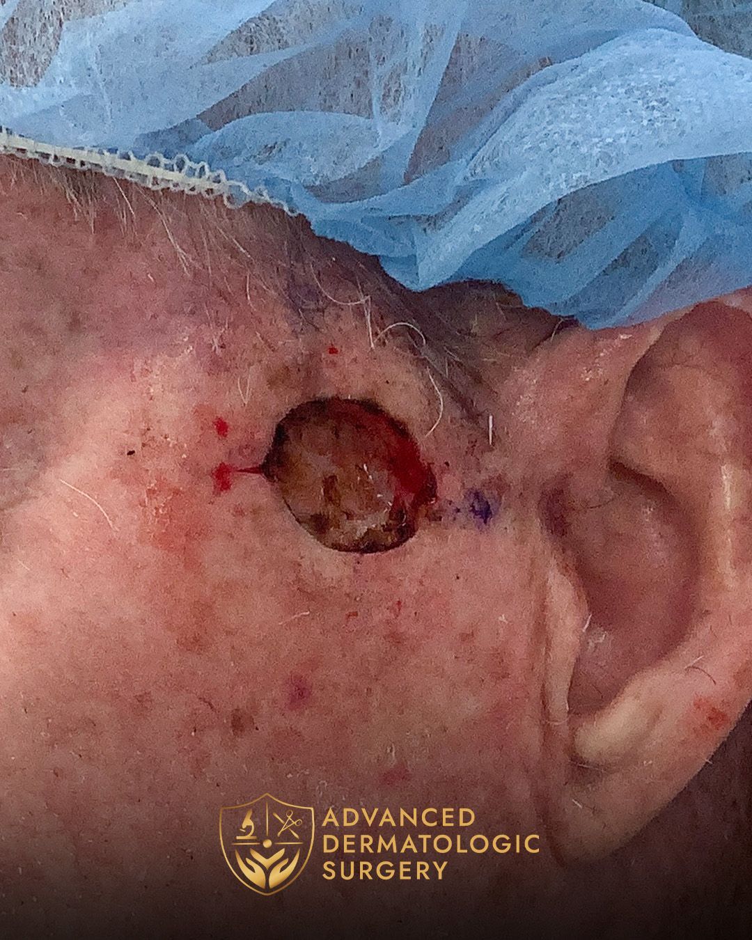 Close up of a MOHS surgery spot on the temple