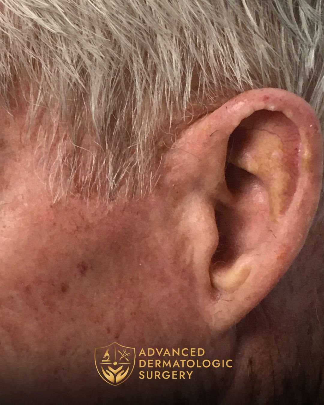 Fully healed temple of a man who underwent MOHS surgery