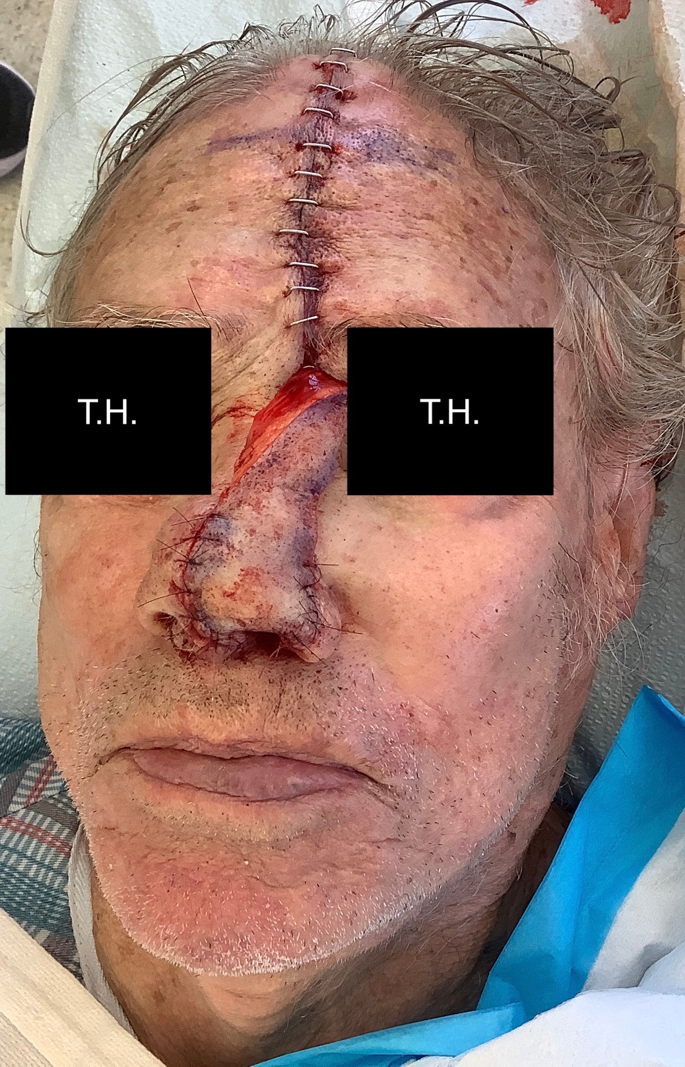 Close-up of a man's face immediately following surgery at Advanced Dermatologic Surgery in Overland Park, KS