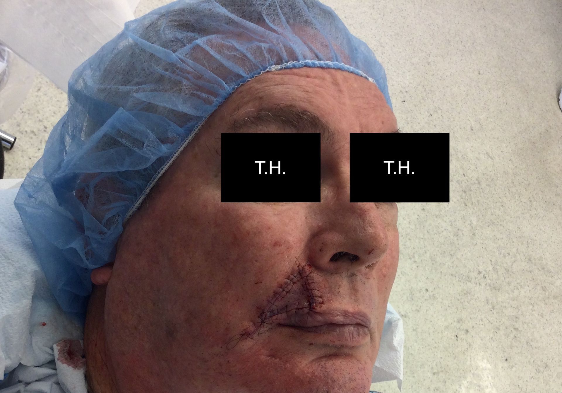 Close up of man who underwent Mohs Surgery at Advanced Dermatologic Surgery in Overland Park, KS