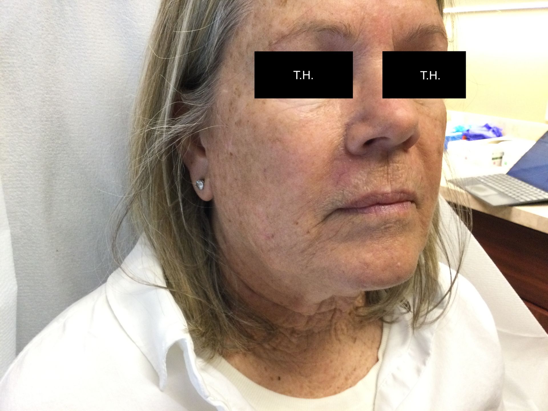 Close up of a woman with minimal scar three-months after Mohs Surgery at Advanced Dermatologic Surgery in Overland Park, KS