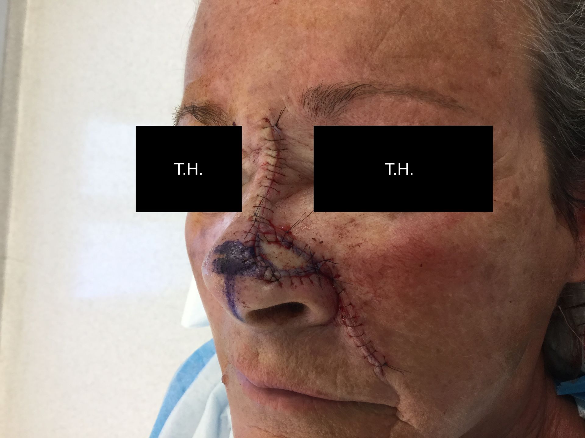 Close up of a woman's face immediately following surgery at Advanced Dermatologic Surgery in Overland Park, KS