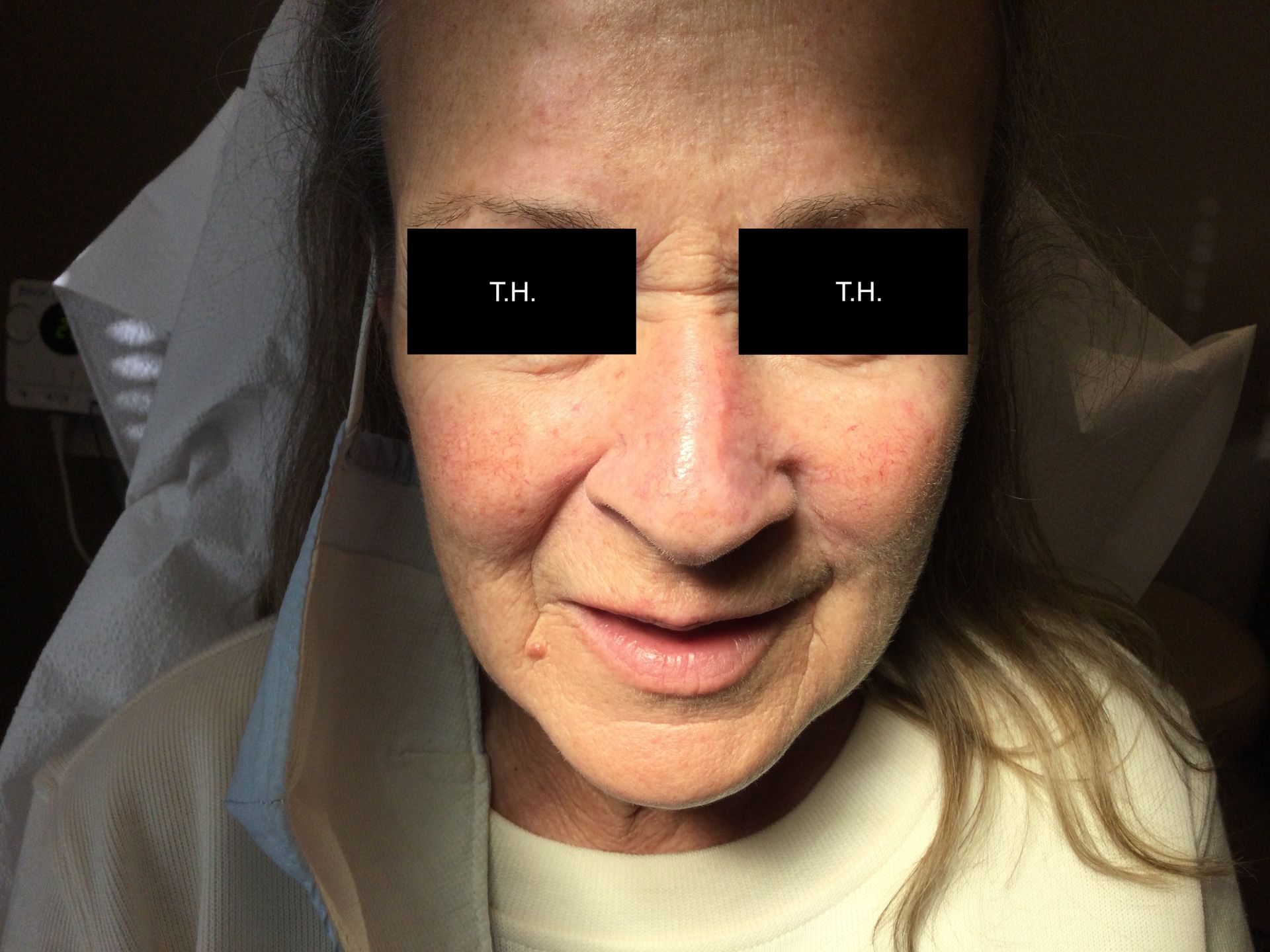 A close up of a woman 's face. 6 month mohs follow up at Advanced Dermatologic Surgery in Overland Park, KS